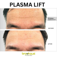 60% OFF ON PLASMA LIFT: FOREHEAD - 4 SESSIONS *