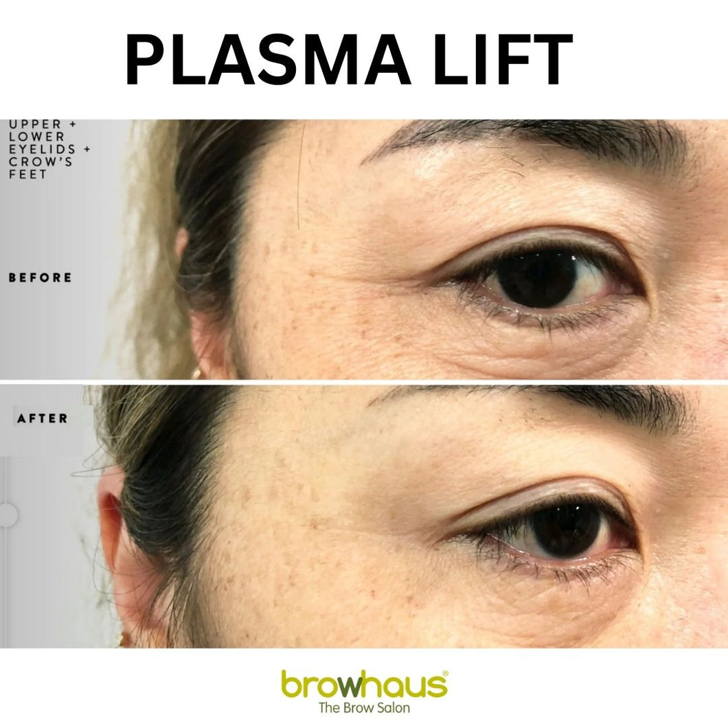 50% OFF ON PLASMA LIFT: UPPER AND LOWER EYELID + CROW'S FEET 1 SESSION