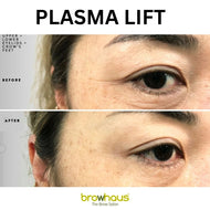 70% OFF ON PLASMA LIFT: UPPER AND LOWER EYELID *