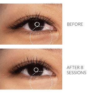 Browhaus 50% OFF ON PLASMA LIFT: LOWER EYELID 1 SESSION