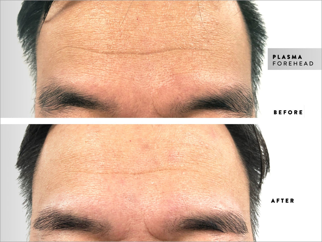 Browhaus 50% OFF ON PLASMA LIFT: FOREHEAD 1 SESSION
