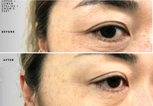 Load image into Gallery viewer, PLASMA LIFT: UPPER AND LOWER EYELID + CROW&#39;S FEET TRIAL SESSION
