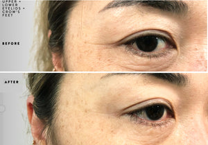 PLASMA LIFT: UPPER AND LOWER EYELID + CROW'S FEET TRIAL SESSION