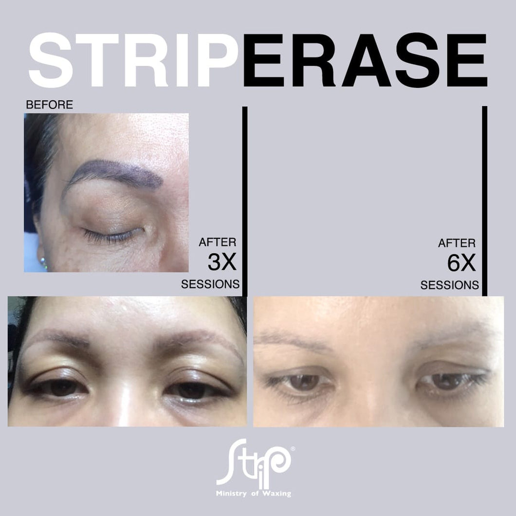 4 SESSIONS OF EYEBROW TATTOO REMOVAL (FOR FEMALE)